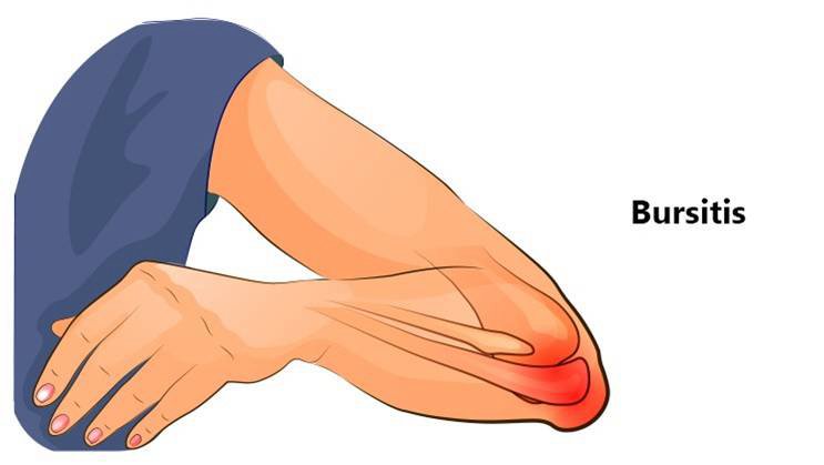 bursitis