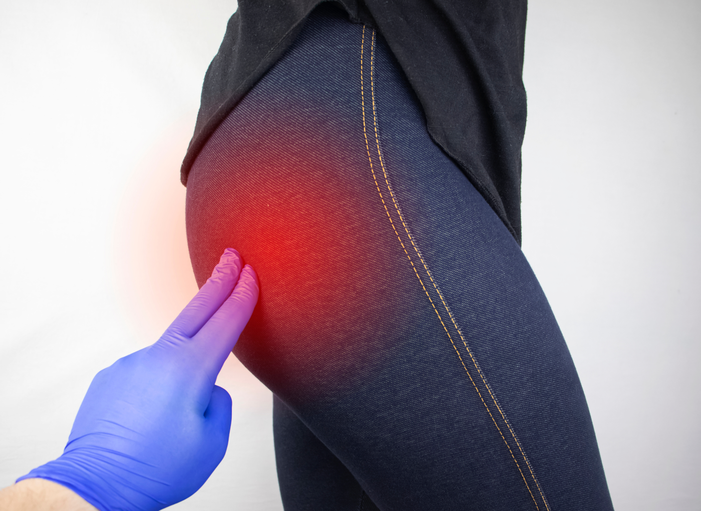 A piriformis szindróma: Megkérdeztük a gyógytornászt